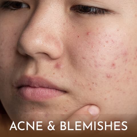 Acne and Blemishes