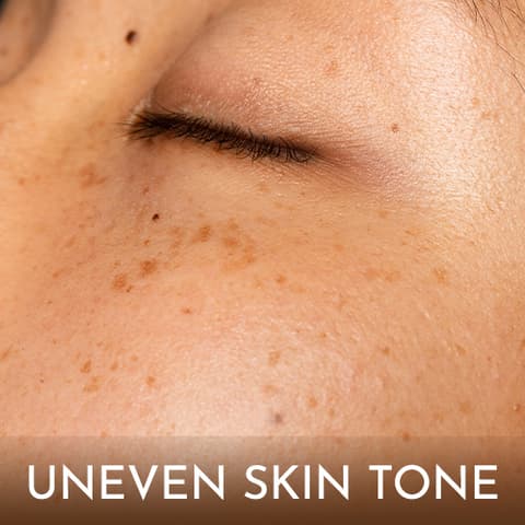 Uneven Skin Tone